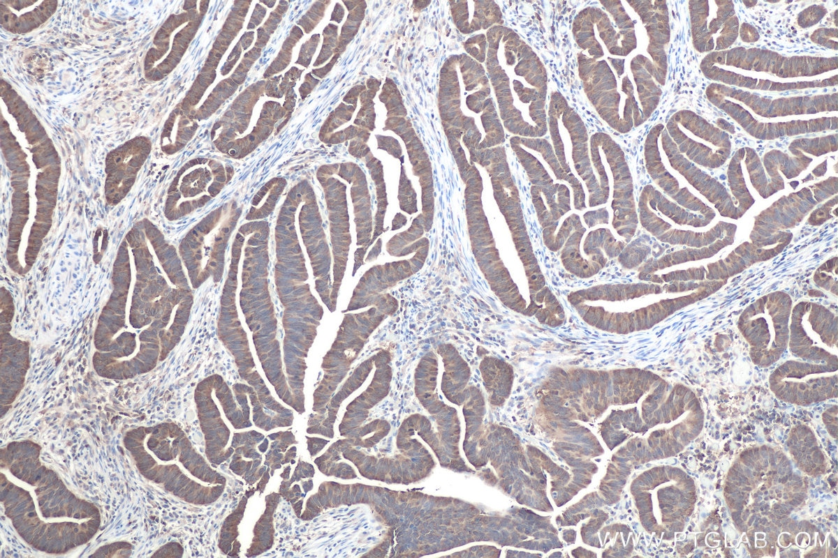 Immunohistochemical analysis of paraffin-embedded human colon cancer tissue slide using KHC0868 (CACYBP IHC Kit).