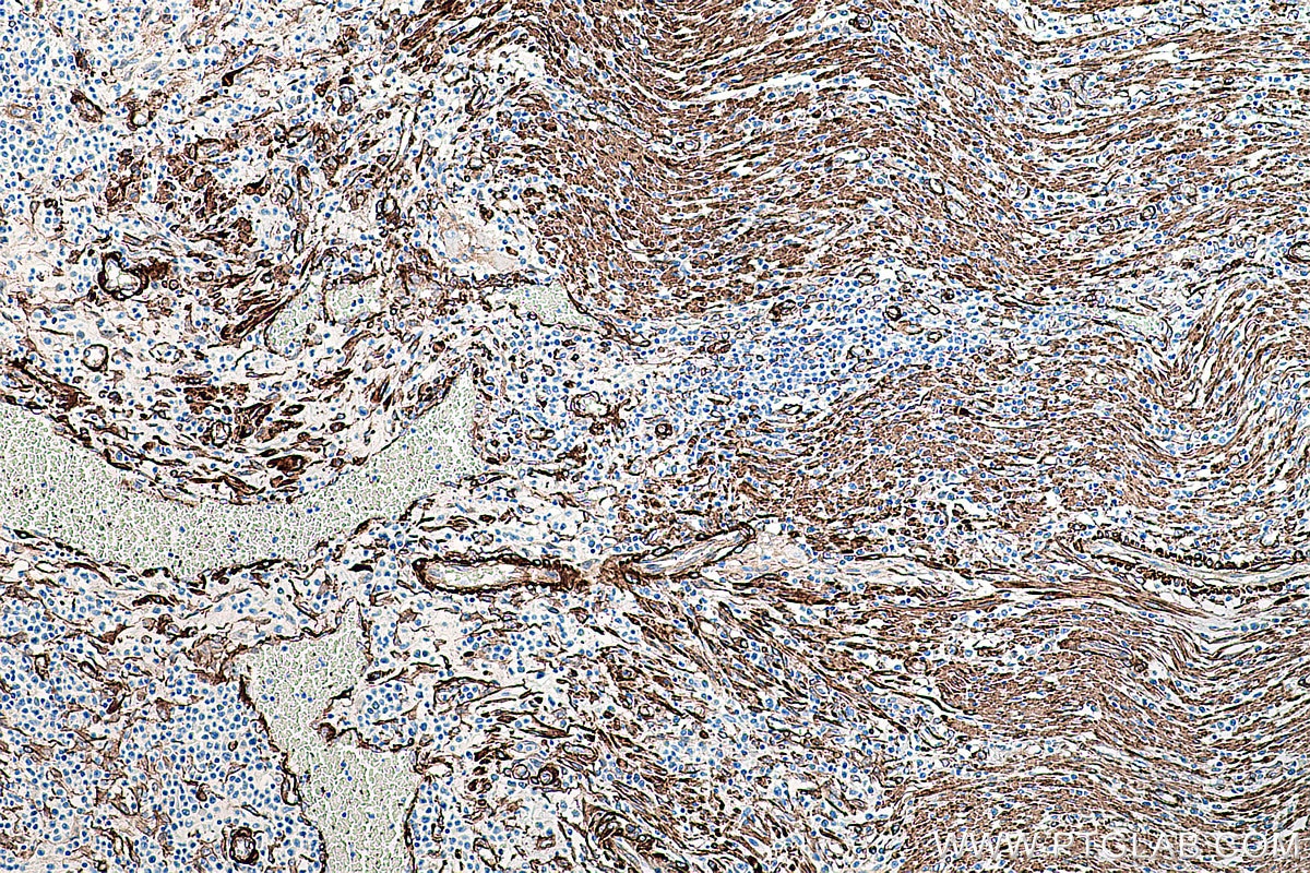 Immunohistochemical analysis of paraffin-embedded human colon cancer tissue slide using KHC0274 (CALD1 IHC Kit).