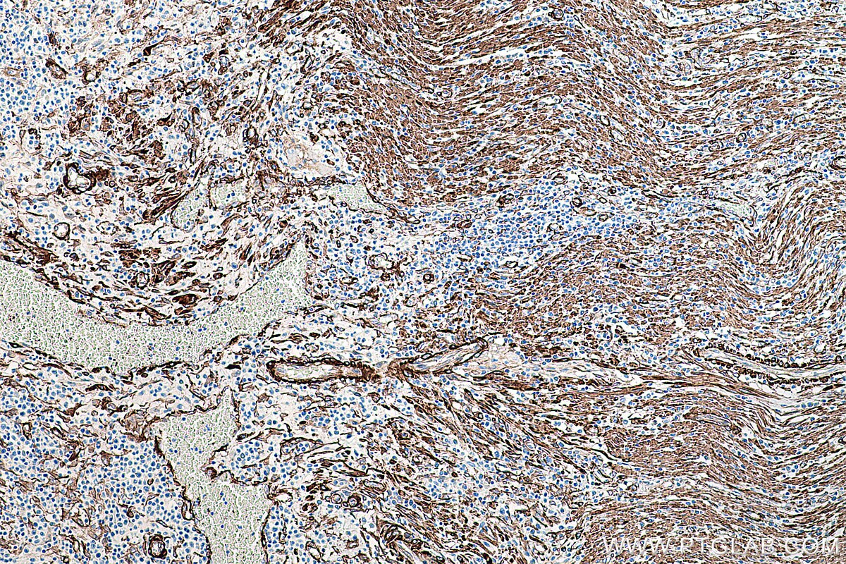 Immunohistochemical analysis of paraffin-embedded human colon cancer tissue slide using KHC0274 (CALD1 IHC Kit).