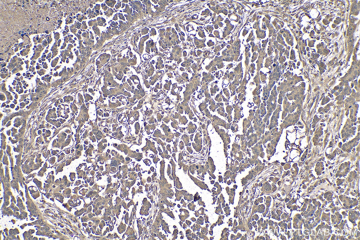 Immunohistochemical analysis of paraffin-embedded human colon cancer tissue slide using KHC0795 (CALU IHC Kit).