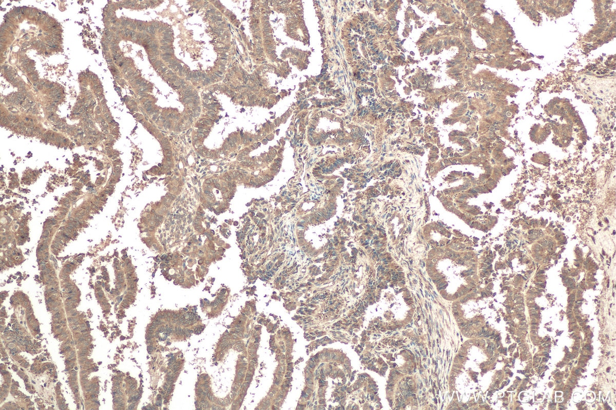 Immunohistochemical analysis of paraffin-embedded human ovary tumor tissue slide using KHC0795 (CALU IHC Kit).