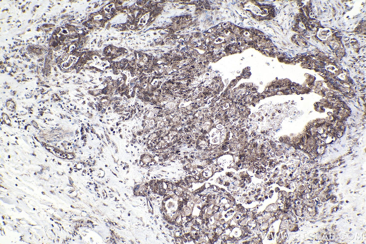 Immunohistochemical analysis of paraffin-embedded human pancreas cancer tissue slide using KHC1724 (CAMK1 IHC Kit).
