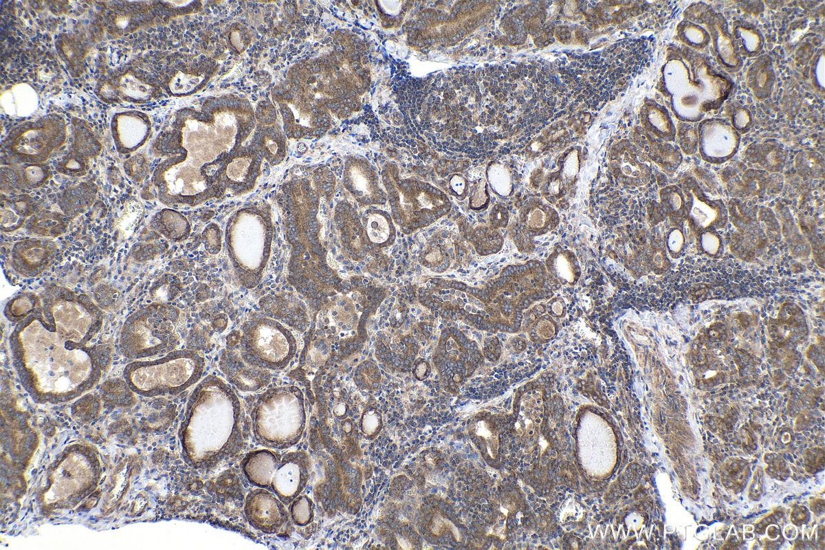 Immunohistochemical analysis of paraffin-embedded human thyroid cancer tissue slide using KHC1724 (CAMK1 IHC Kit).