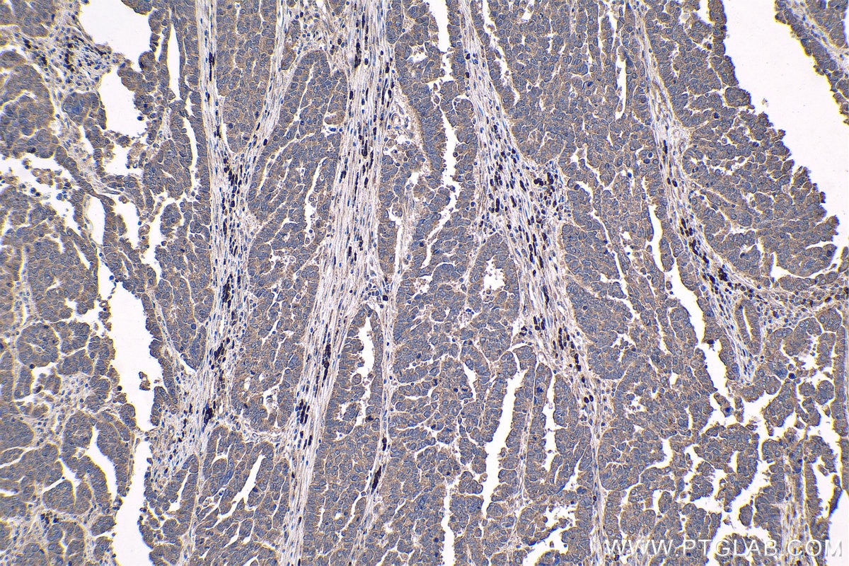 Immunohistochemical analysis of paraffin-embedded human ovary tumor tissue slide using KHC1816 (CAMK1D IHC Kit).