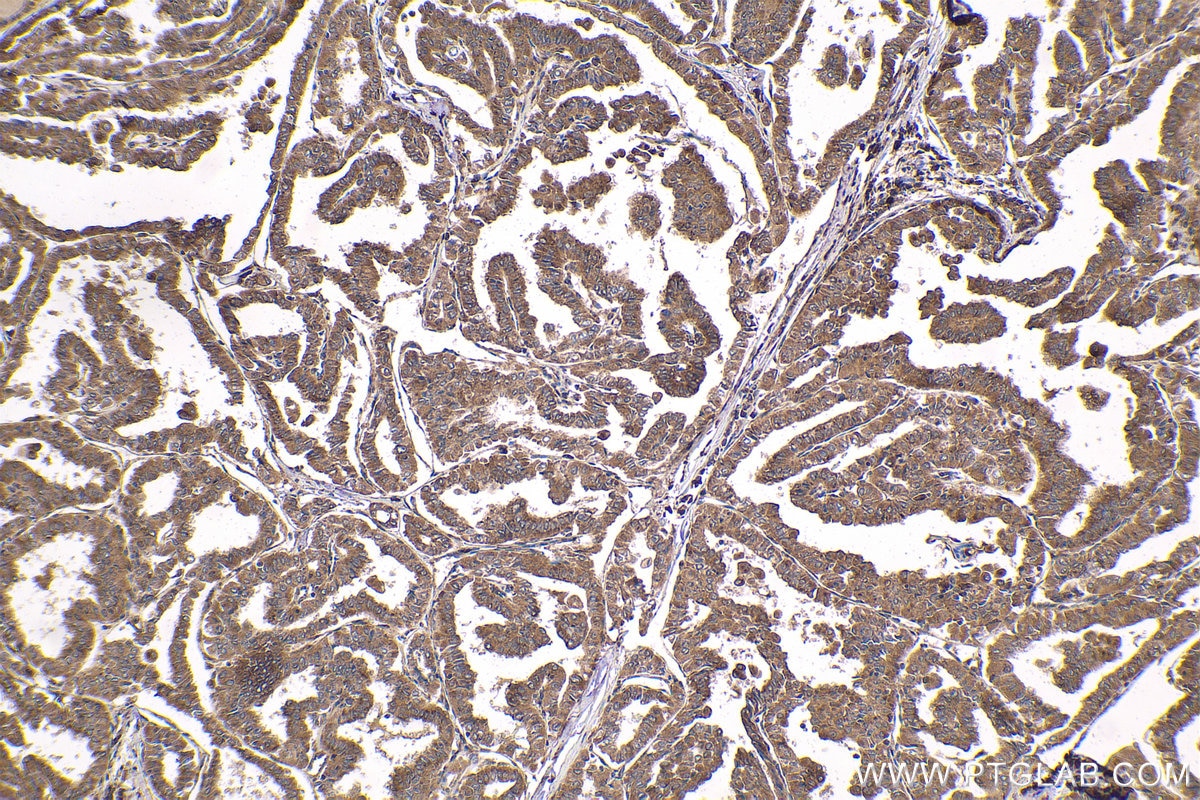 Immunohistochemical analysis of paraffin-embedded human thyroid cancer tissue slide using KHC1816 (CAMK1D IHC Kit).