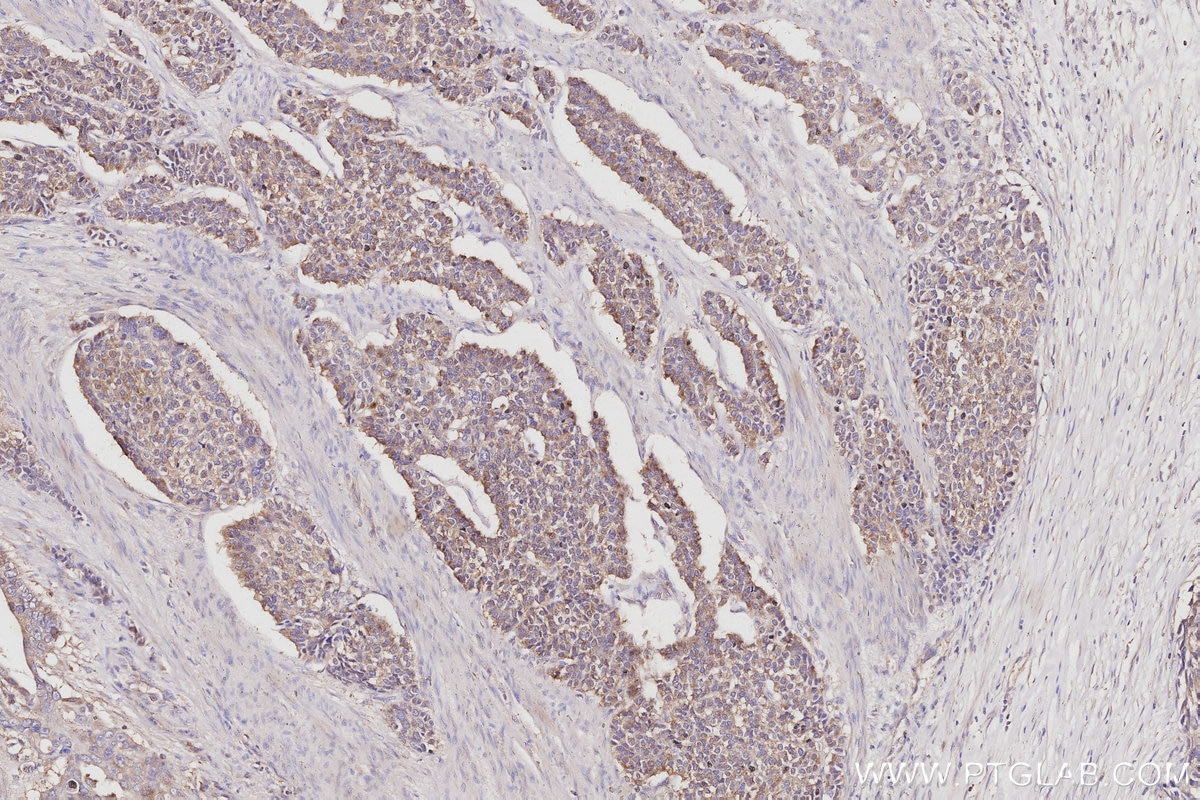 Immunohistochemical analysis of paraffin-embedded human stomach cancer tissue slide using KHC3050 (CAMK2A IHC Kit). Immunohistochemical analysis of paraffin-embedded human stomach cancer tissue slide using KHC3050 (CAMK2A IHC Kit).
