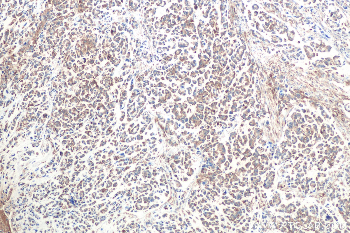 Immunohistochemical analysis of paraffin-embedded human colon cancer tissue slide using KHC0835 (CAP1 IHC Kit).