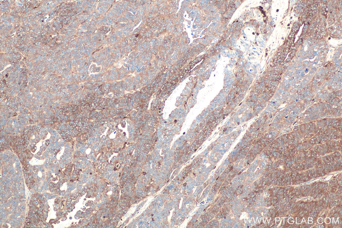 Immunohistochemical analysis of paraffin-embedded human ovary tumor tissue slide using KHC0835 (CAP1 IHC Kit).