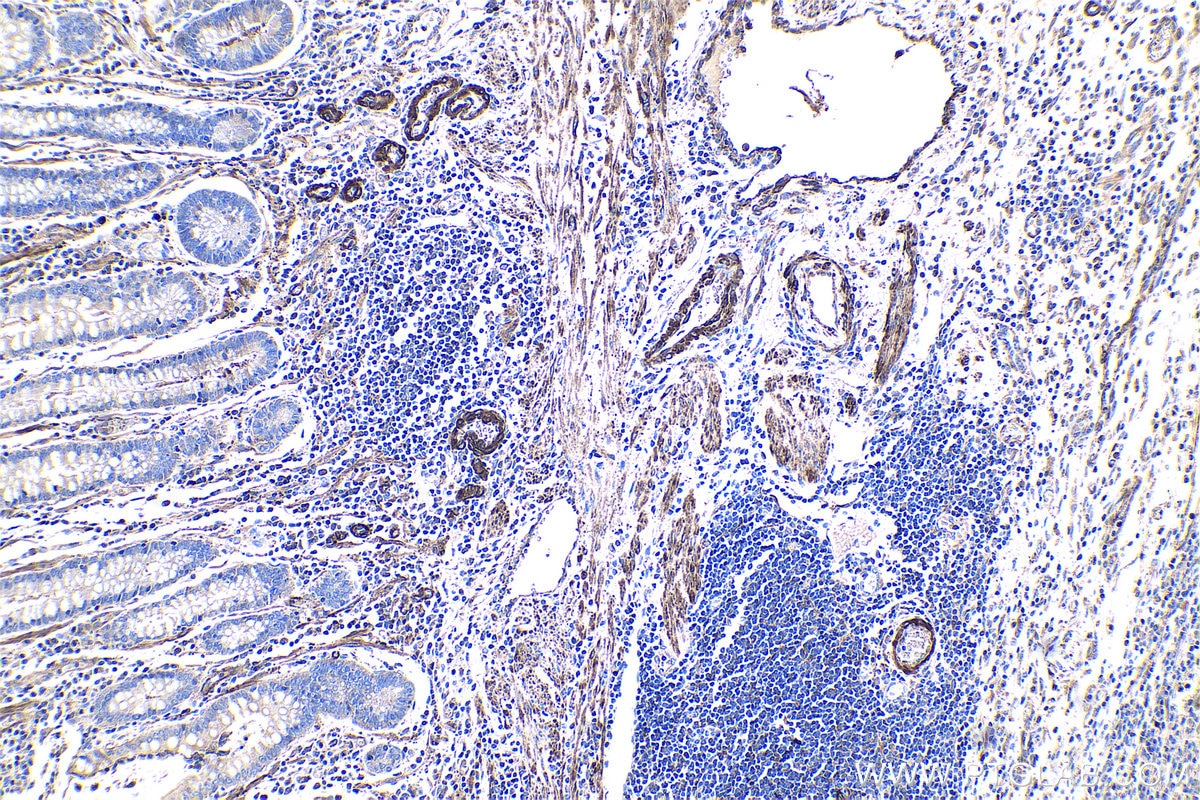 Immunohistochemical analysis of paraffin-embedded human stomach cancer tissue slide using KHC0969 (CAP2 IHC Kit).