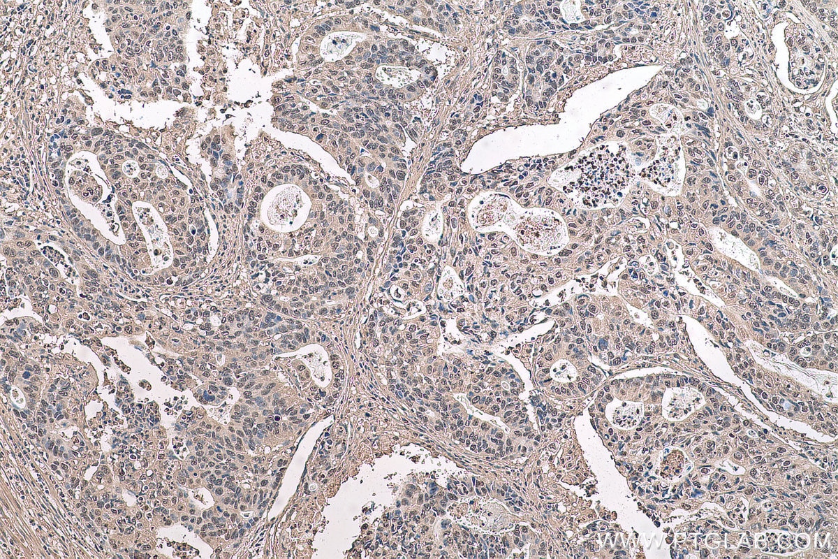 Immunohistochemical analysis of paraffin-embedded human stomach cancer tissue slide using KHC0709 (CAPG IHC Kit).