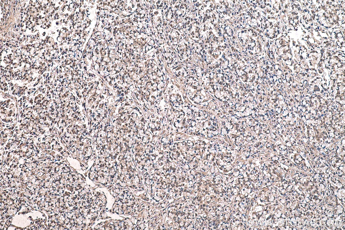 Immunohistochemical analysis of paraffin-embedded human colon cancer tissue slide using KHC0709 (CAPG IHC Kit).