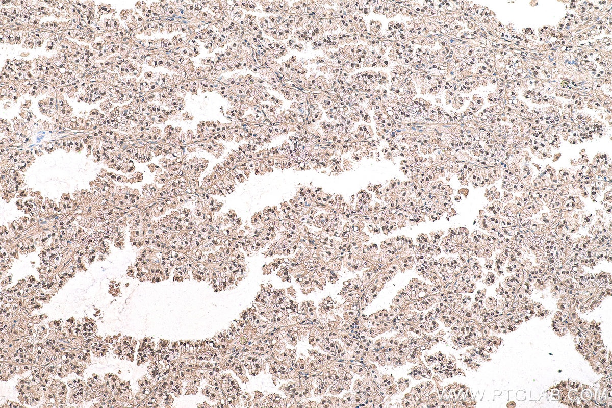 Immunohistochemical analysis of paraffin-embedded human lung cancer tissue slide using KHC0709 (CAPG IHC Kit).
