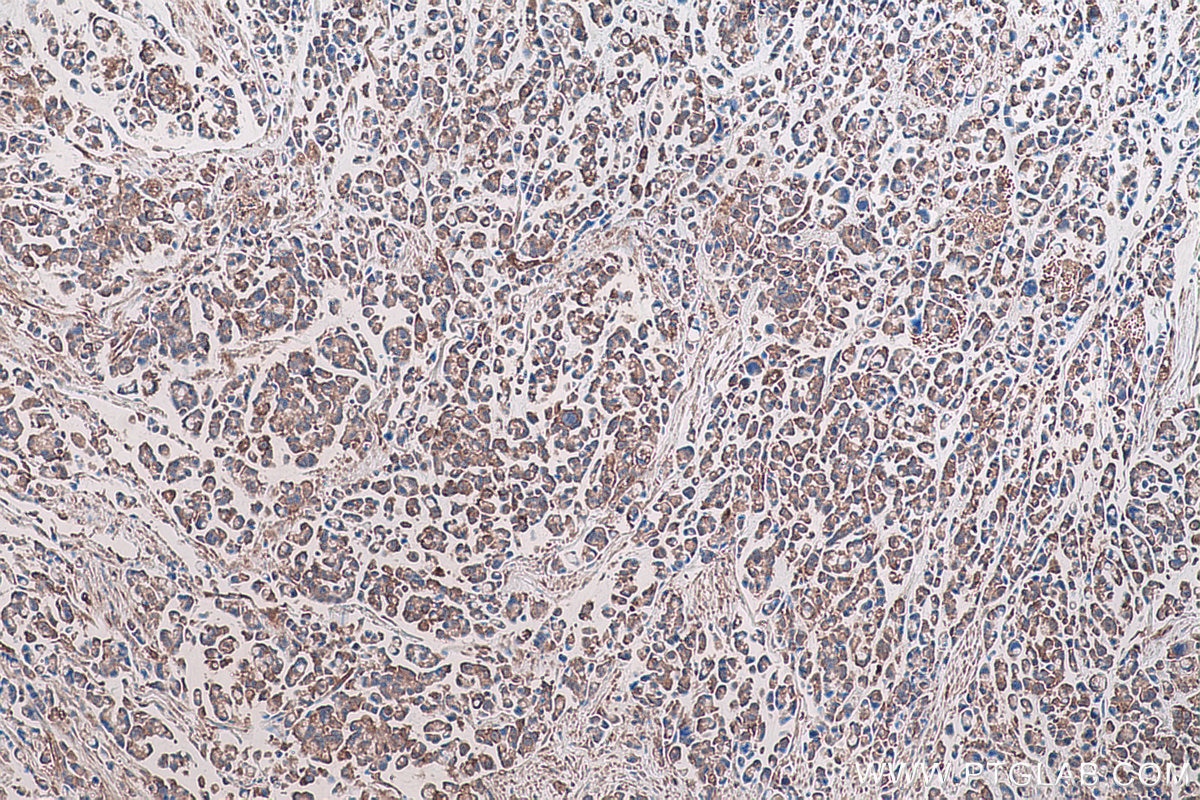 Immunohistochemical analysis of paraffin-embedded human colon cancer tissue slide using KHC0724 (CAPN2 IHC Kit).