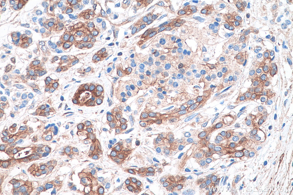 Immunohistochemical analysis of paraffin-embedded human pancreas cancer tissue slide using KHC0724 (CAPN2 IHC Kit).