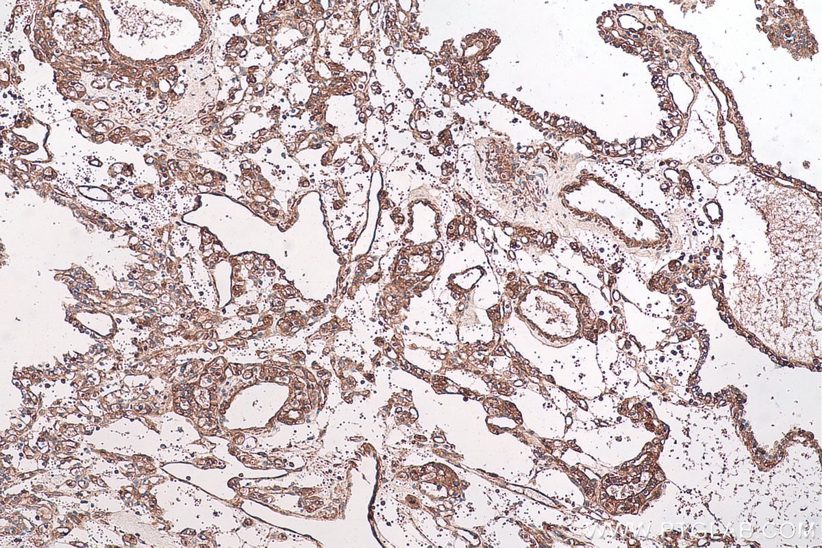 Immunohistochemical analysis of paraffin-embedded human renal cell carcinoma tissue slide using KHC0724 (CAPN2 IHC Kit).