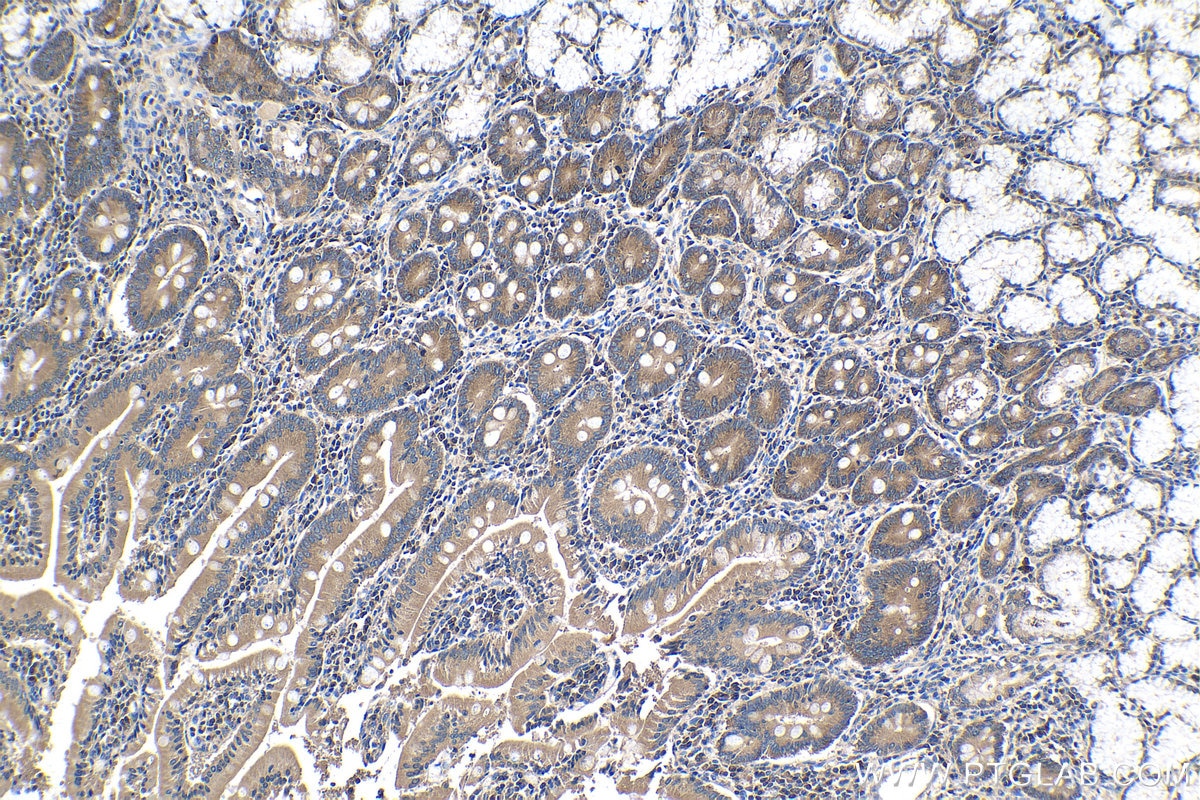 Immunohistochemical analysis of paraffin-embedded human stomach cancer tissue slide using KHC1395 (CAPRIN1 IHC Kit).