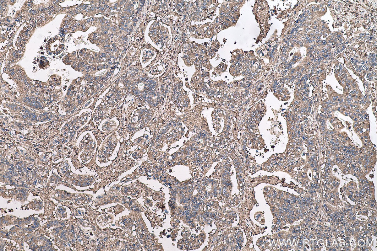 Immunohistochemical analysis of paraffin-embedded human stomach cancer tissue slide using KHC0707 (CAPZB IHC Kit).