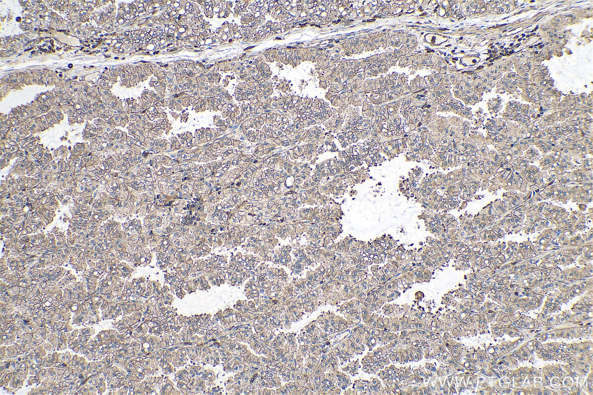 Immunohistochemical analysis of paraffin-embedded human lung cancer tissue slide using KHC0707 (CAPZB IHC Kit).