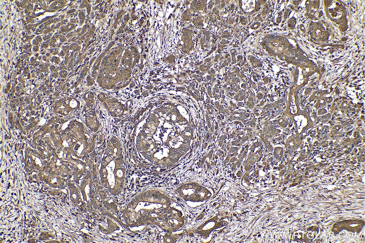 Immunohistochemical analysis of paraffin-embedded human pancreas cancer tissue slide using KHC0707 (CAPZB IHC Kit).