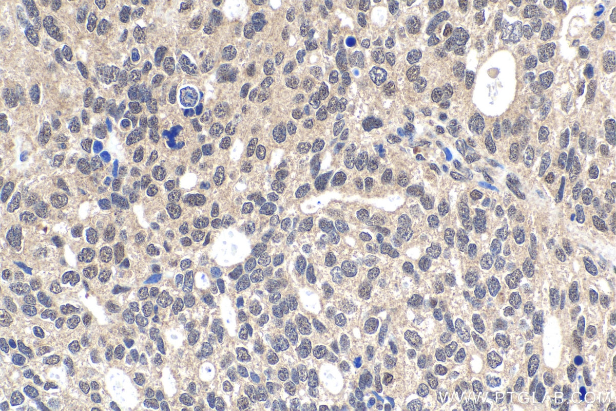 Immunohistochemical analysis of paraffin-embedded human ovary tumor tissue slide using KHC1810 (CARM1 IHC Kit).