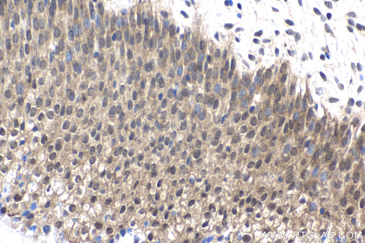 Immunohistochemical analysis of paraffin-embedded human urothelial carcinoma tissue slide using KHC1810 (CARM1 IHC Kit).