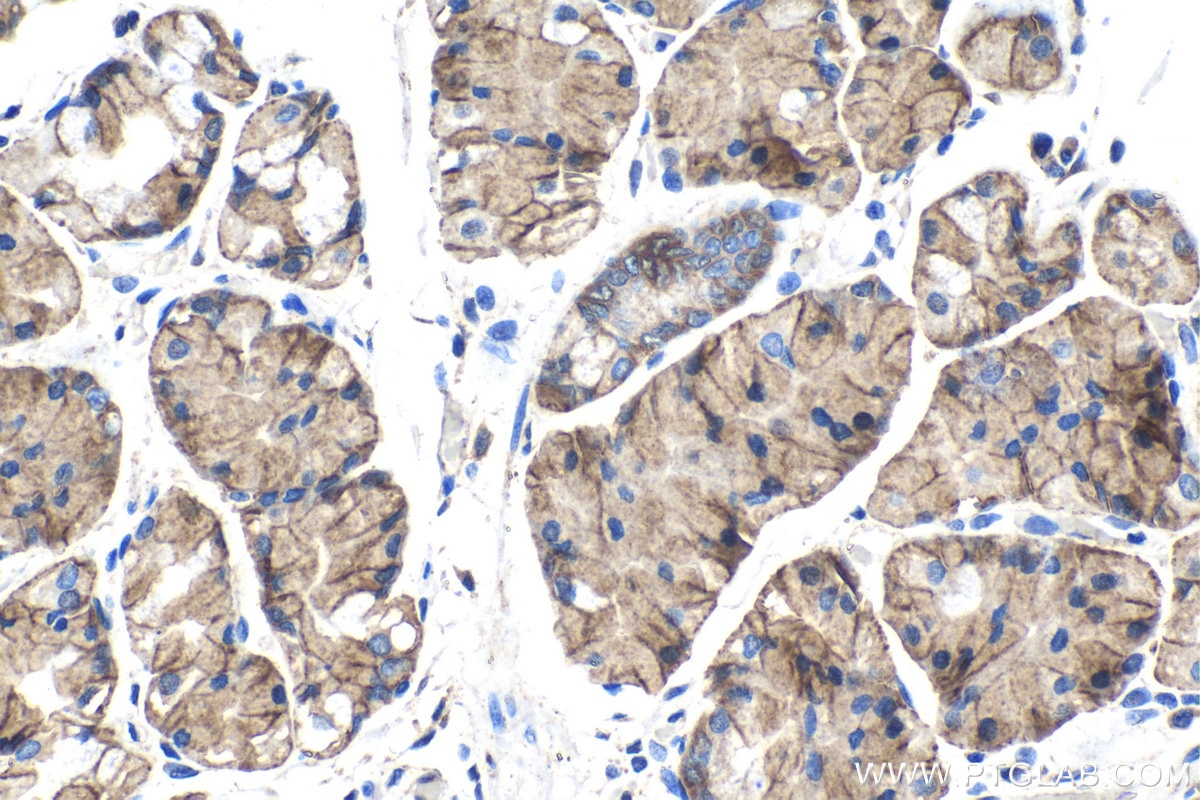 Immunohistochemical analysis of paraffin-embedded human stomach cancer tissue slide using KHC1433 (CASK IHC Kit).
