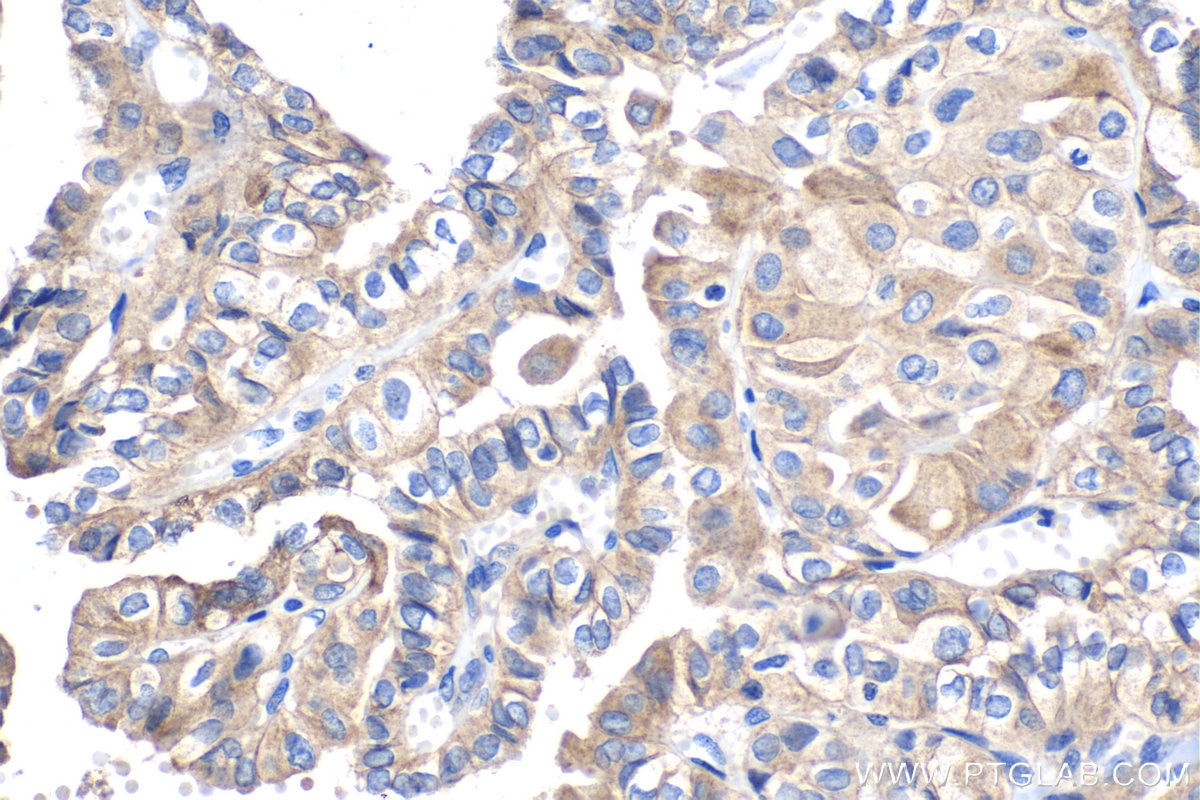 Immunohistochemical analysis of paraffin-embedded human thyroid cancer tissue slide using KHC1433 (CASK IHC Kit).