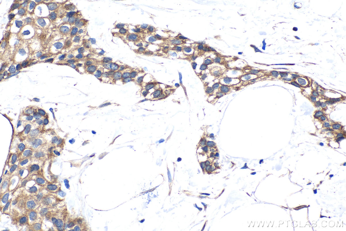 Immunohistochemical analysis of paraffin-embedded human urothelial carcinoma tissue slide using KHC1433 (CASK IHC Kit).