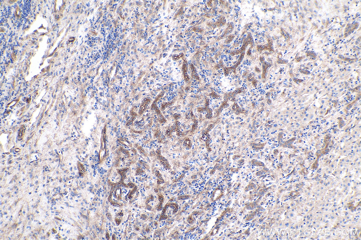 Immunohistochemical analysis of paraffin-embedded human liver cancer tissue slide using KHC0406 (CASP7 IHC Kit).