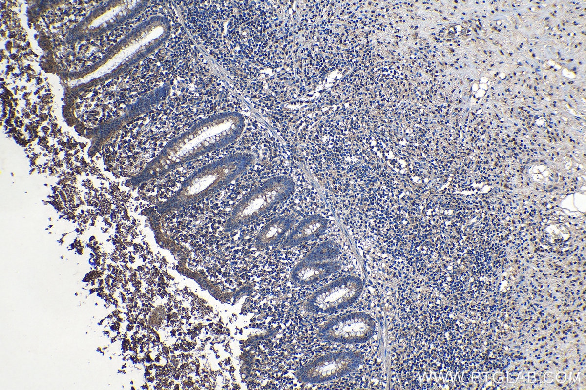 Immunohistochemical analysis of paraffin-embedded human appendicitis tissue slide using KHC1312 (CASP8 IHC Kit).