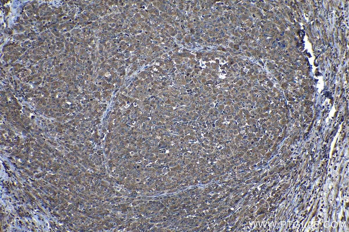 Immunohistochemical analysis of paraffin-embedded human lymphoma tissue slide using KHC1312 (CASP8 IHC Kit).