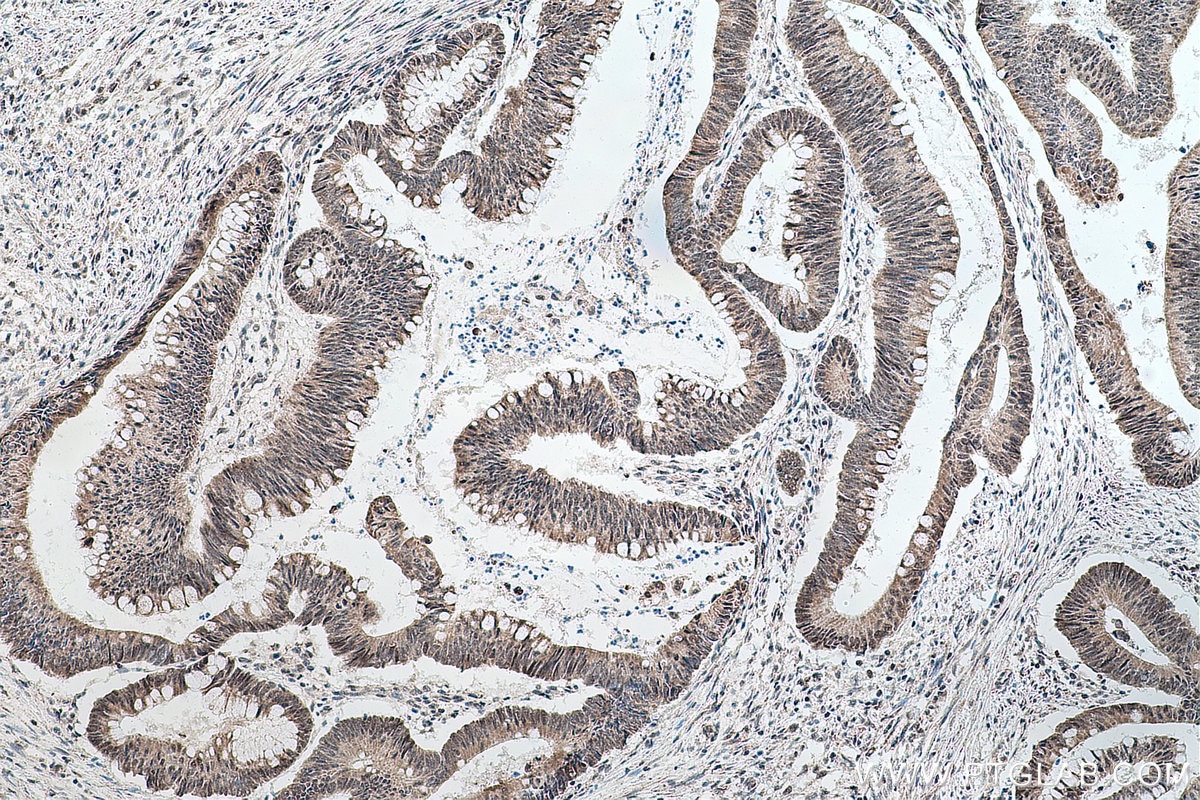 Immunohistochemical analysis of paraffin-embedded human colon cancer tissue slide using KHC0152 (CBLL1 IHC Kit).