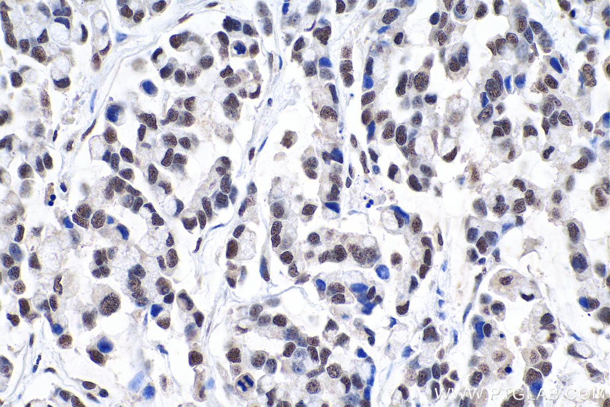 Immunohistochemical analysis of paraffin-embedded human colon cancer tissue slide using KHC0920 (CBX1 IHC Kit).