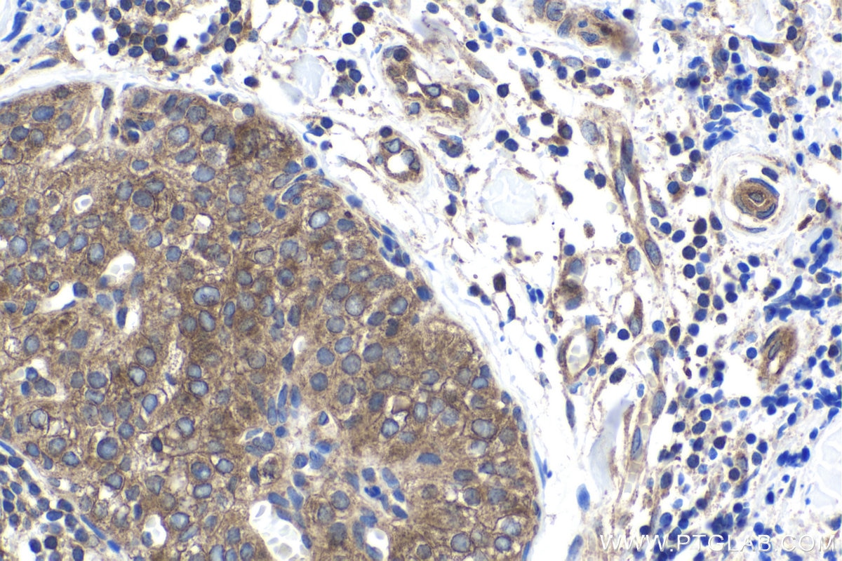 Immunohistochemical analysis of paraffin-embedded human thyroid cancer tissue slide using KHC1789 (CC2D1A IHC Kit).