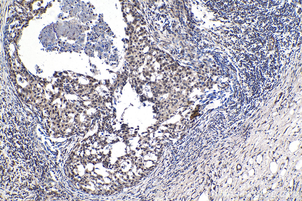 Immunohistochemical analysis of paraffin-embedded human breast cancer tissue slide using KHC1377 (CCAR1 IHC Kit).