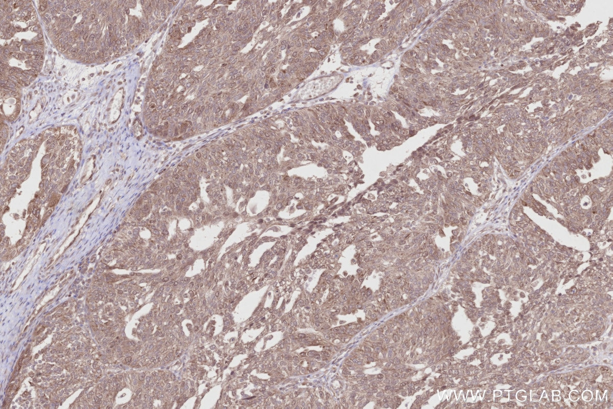Immunohistochemical analysis of paraffin-embedded human ovary cancer tissue slide using KHC2810 (CCDC115 IHC Kit).