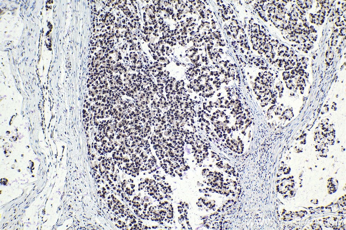 Immunohistochemical analysis of paraffin-embedded human colon cancer tissue slide using KHC1044 (CCDC12 IHC Kit).