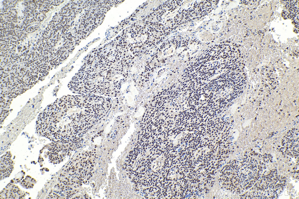Immunohistochemical analysis of paraffin-embedded human ovary tumor tissue slide using KHC1044 (CCDC12 IHC Kit).