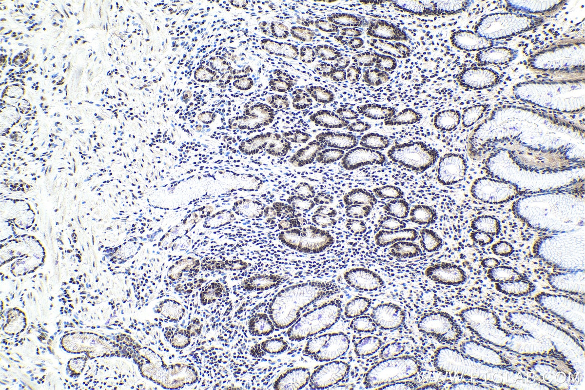 Immunohistochemical analysis of paraffin-embedded human stomach cancer tissue slide using KHC1044 (CCDC12 IHC Kit).