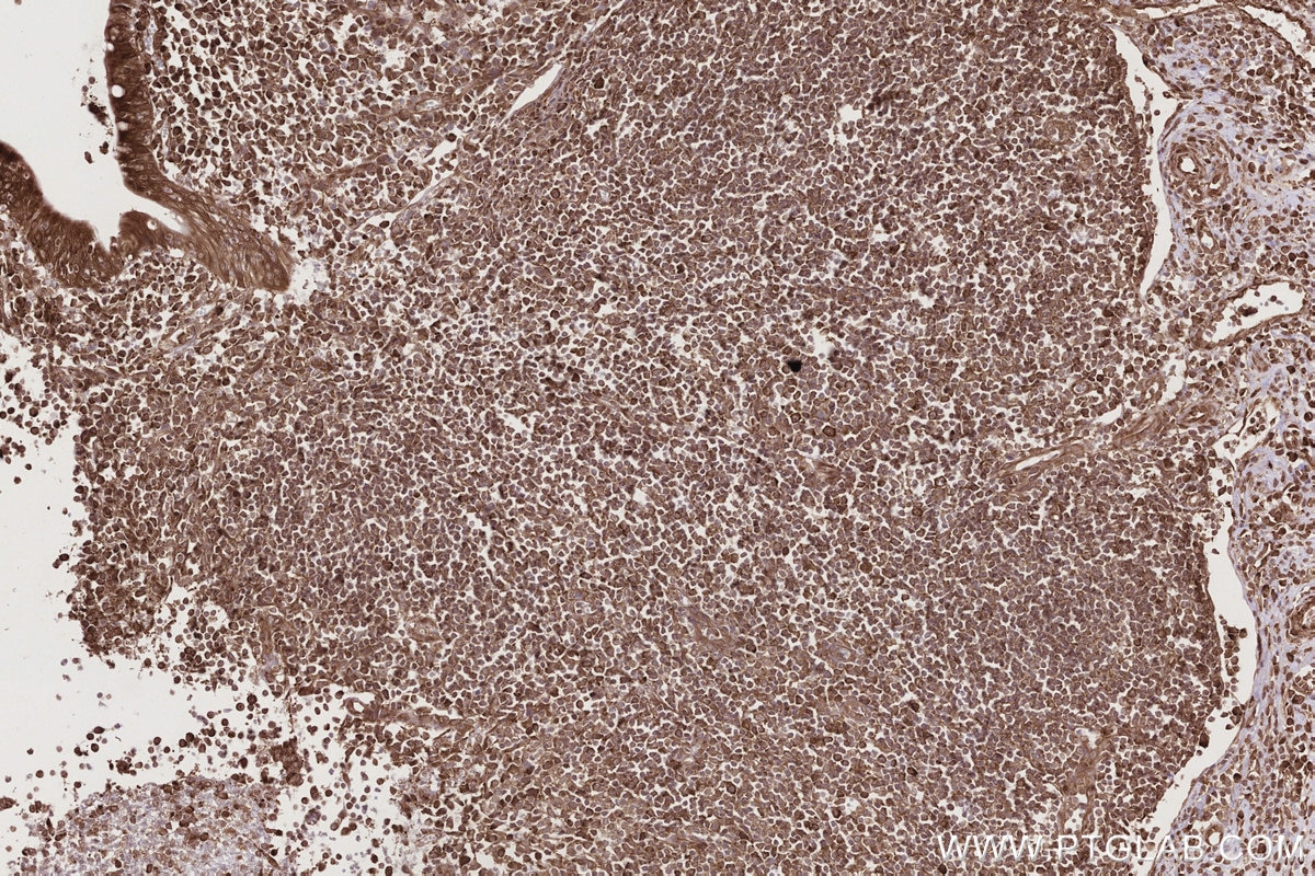 Immunohistochemical analysis of paraffin-embedded human appendicitis tissue slide using KHC2784 (CCDC124 IHC Kit).
