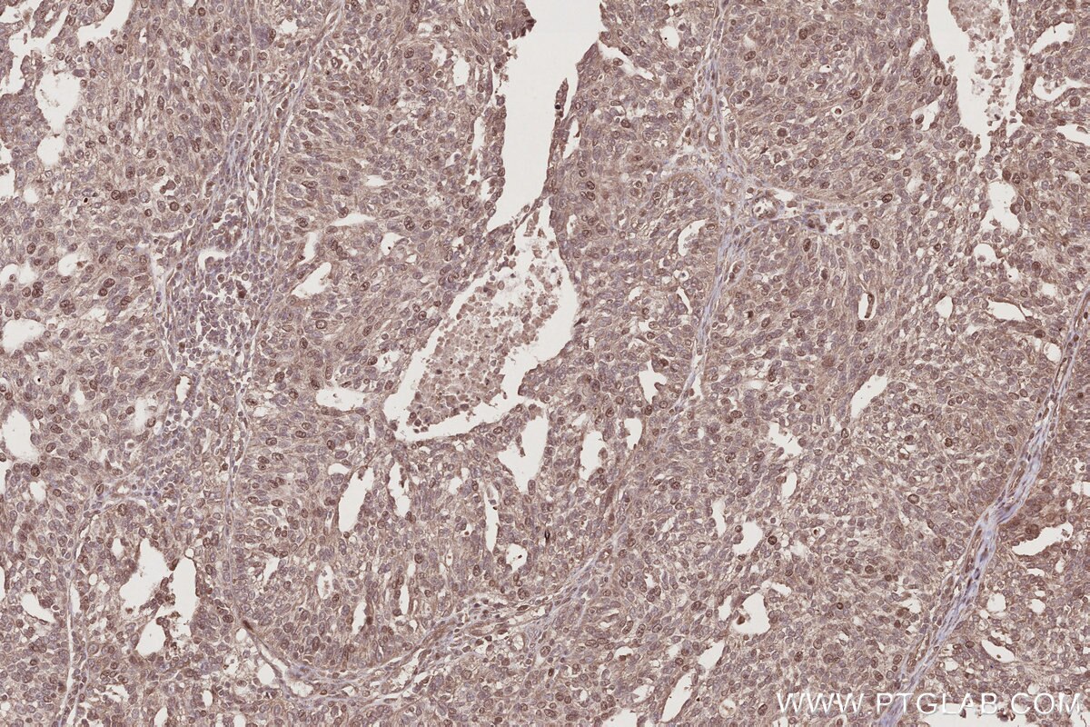 Immunohistochemical analysis of paraffin-embedded human ovary cancer tissue slide using KHC2787 (CCDC99 IHC Kit).