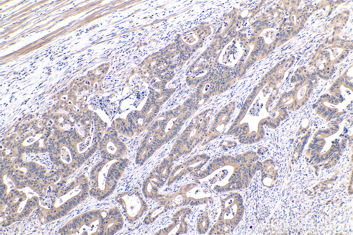 Immunohistochemical analysis of paraffin-embedded human colon cancer tissue slide using KHC0407 (CCL20/MIP3A IHC Kit).