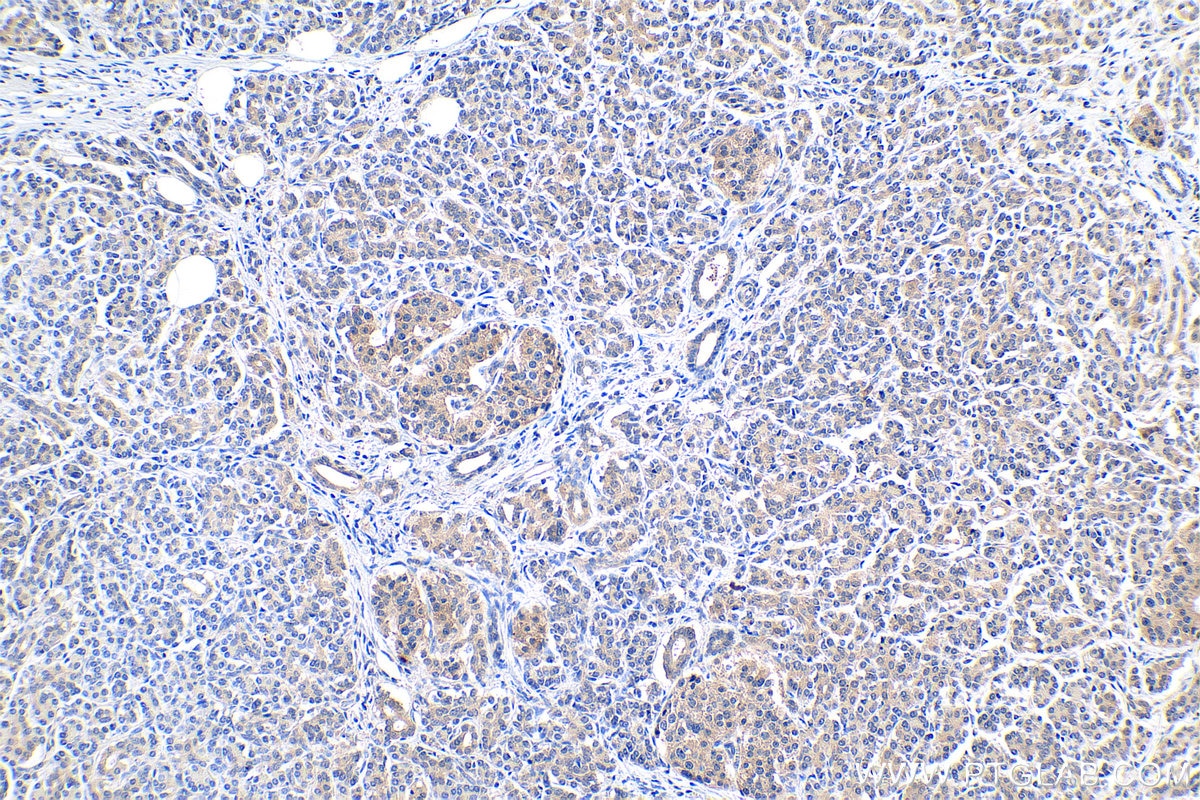 Immunohistochemical analysis of paraffin-embedded human pancreas cancer tissue slide using KHC0407 (CCL20/MIP3A IHC Kit).