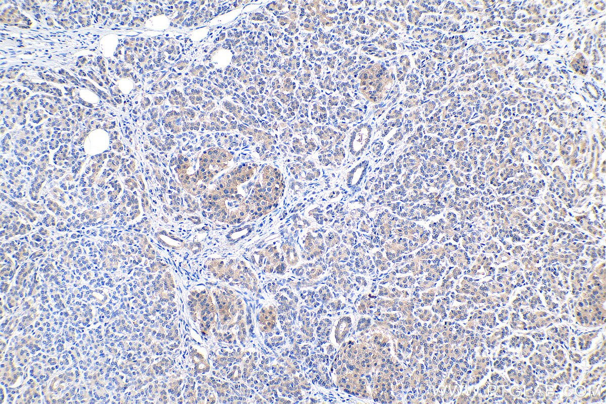 Immunohistochemical analysis of paraffin-embedded human pancreas cancer tissue slide using KHC0407 (CCL20/MIP3A IHC Kit).