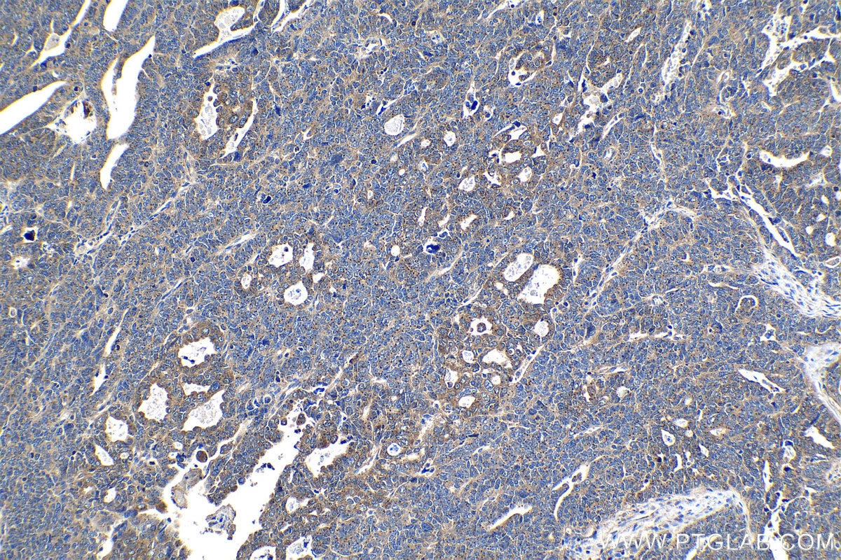 Immunohistochemical analysis of paraffin-embedded human ovary tumor tissue slide using KHC1174 (CCM3/PDCD10 IHC Kit).