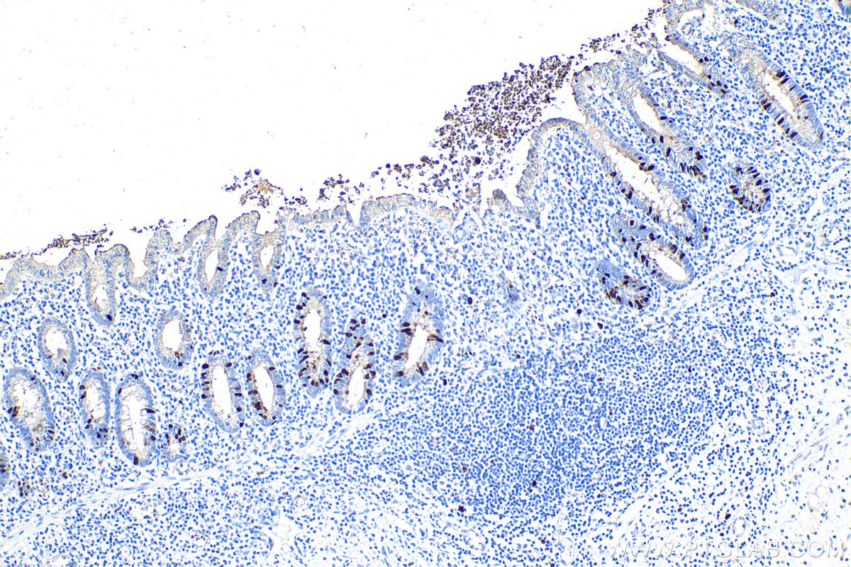 Immunohistochemical analysis of paraffin-embedded human appendicitis tissue slide using KHC1548 (CCNA2 IHC Kit).
