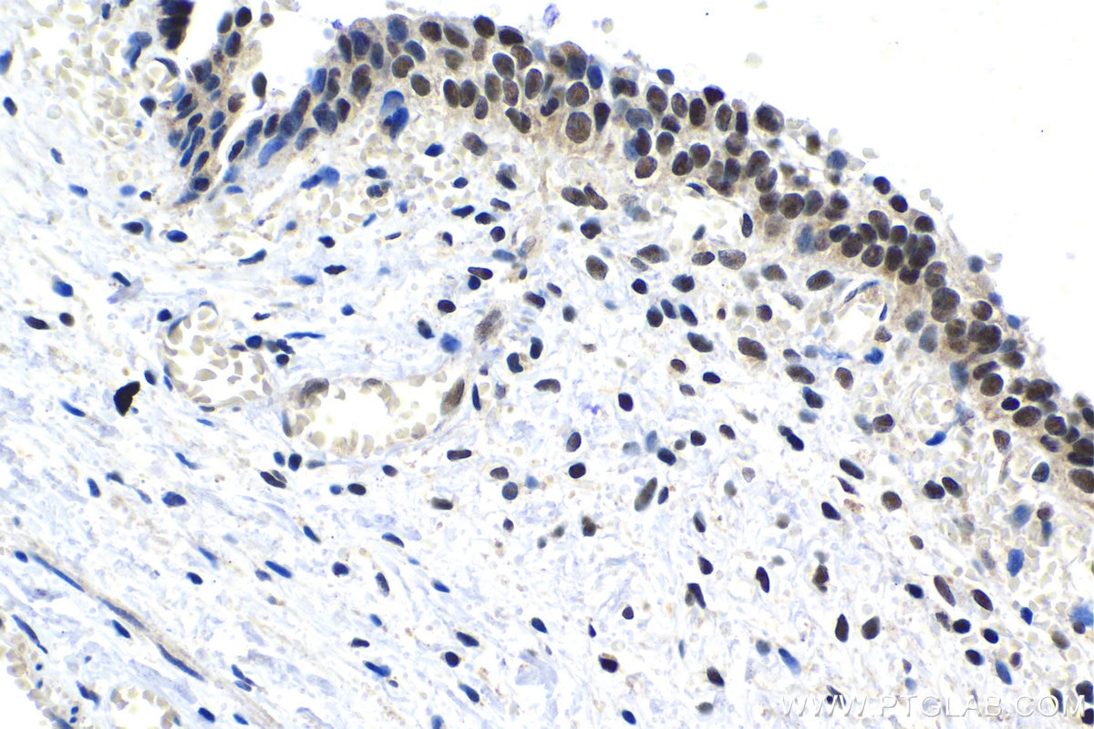 Immunohistochemical analysis of paraffin-embedded human urothelial carcinoma tissue slide using KHC1479 (CCNK IHC Kit).
