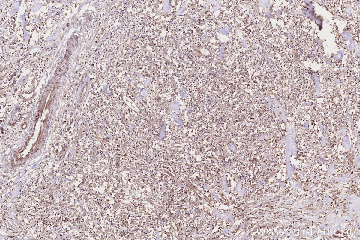 Immunohistochemical analysis of paraffin-embedded human colon cancer tissue slide using KHC3222 (CCT4 IHC Kit).