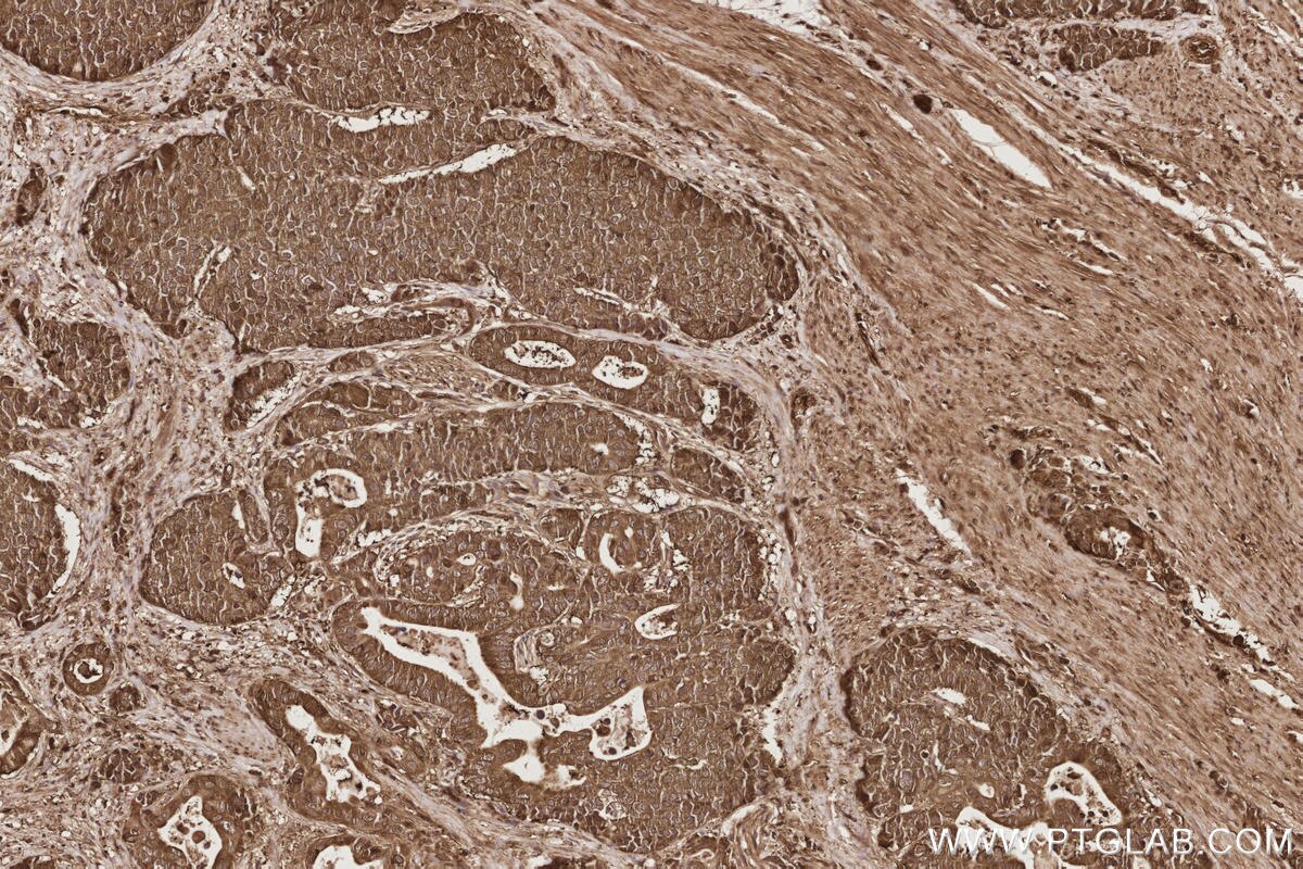 Immunohistochemical analysis of paraffin-embedded human stomach cancer tissue slide using KHC2849 (CCT7 IHC Kit).