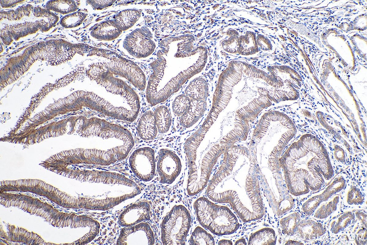 Immunohistochemical analysis of paraffin-embedded human stomach cancer tissue slide using KHC0386 (CD10 IHC Kit).